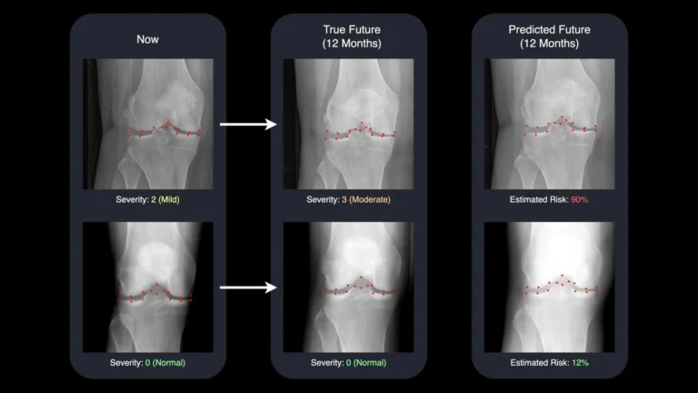 IA transforma radiografias em máquinas do tempo para tratamento de artrite