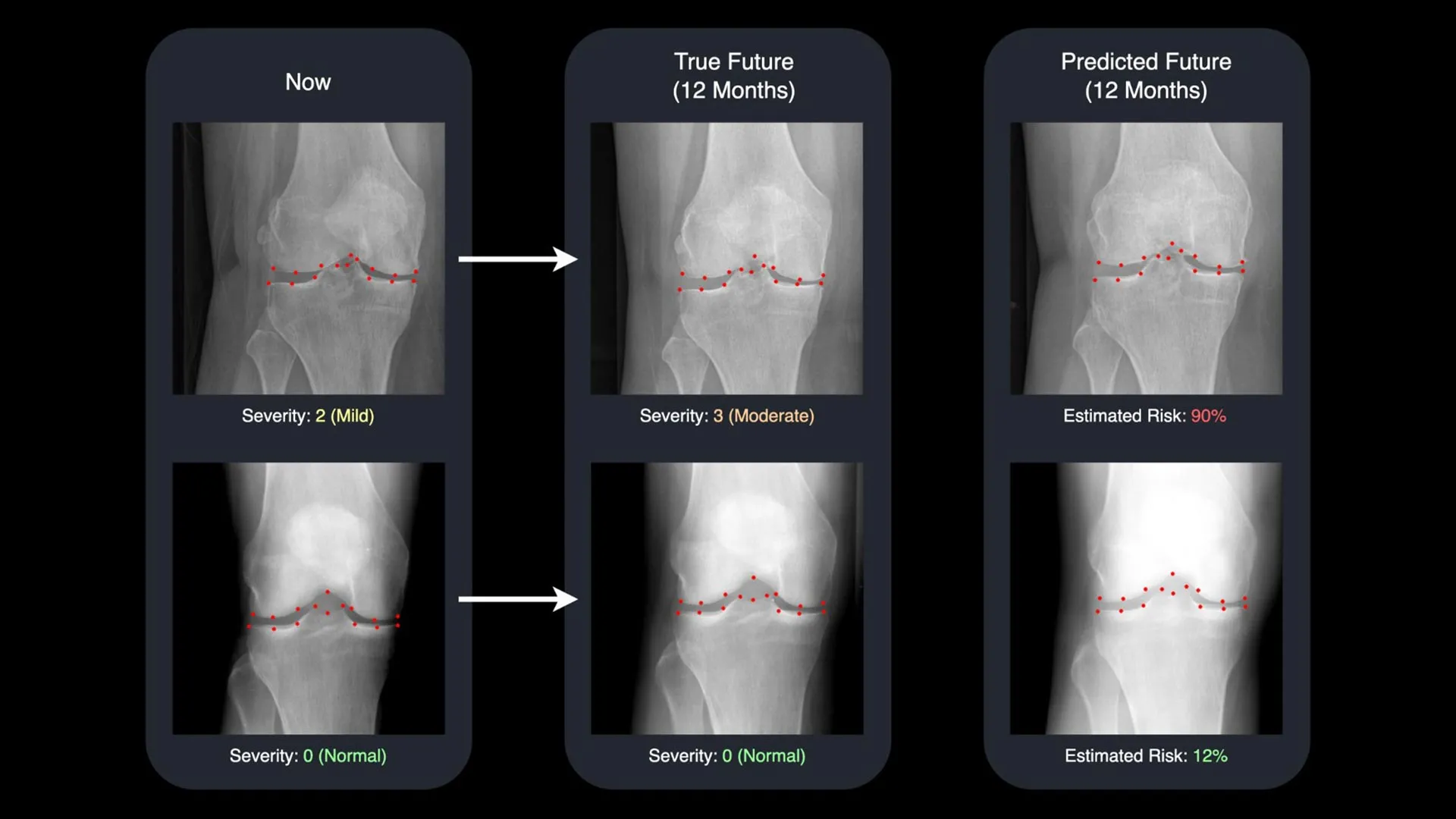 IA transforma radiografias em máquinas do tempo para tratamento de artrite